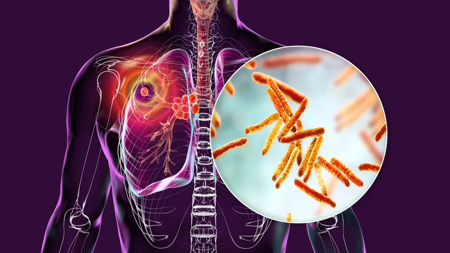 TB gains at risk as funding gap, stigma, malnutrition persist